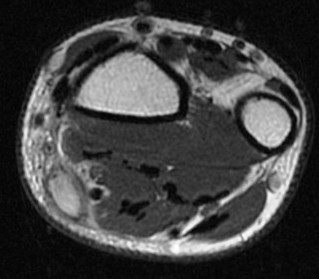 Figure 4 for case Flexor carpi radialis tendon laceration ( RID2388 )